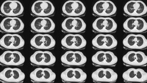 Cáncer de pulmón: expertos estadounidenses publican nuevas pautas para la detección - AlbertoNews