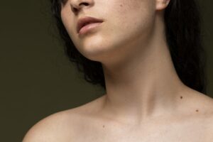 El cáncer de piel debe detectarse a tiempo con un autoexamen