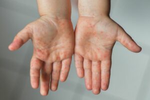 ▷ Alerta en España tras registrarse segunda muerte por la viruela símica #30Jul