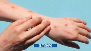 Cartagena confirma primer caso de viruela símica - Otras Ciudades - Colombia
