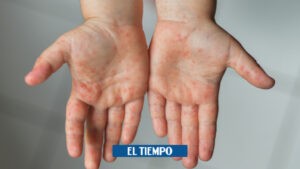 viruela símica en la Guajira: Primer caso confirmado - Otras Ciudades - Colombia