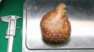 Extirpan la piedra de riñón más pesada y grande del mundo