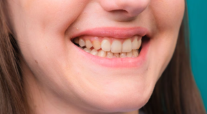 La peligrosa enfermedad bucal capaz de dañar los huesos y romper los dientes