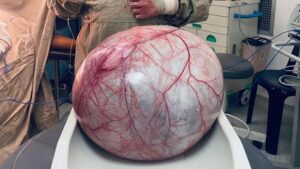 La Guajira: extraen tumor de 12 kilos en Uribia - Otras Ciudades - Colombia