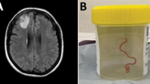 Descubren gusano vivo en el cerebro de una paciente australiana