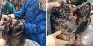 Un VIDEO muestra los pulmones negros de un hombre que fumó 30 años