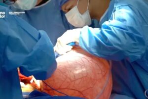 Médicos extirparon tumor ovárico de más de 13 kilos a una mujer en Ecuador