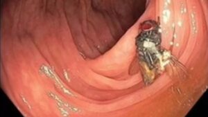 Encuentran una mosca viva dentro de los intestinos de un hombre en Misuri