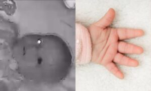 bebÃ© retinoblastoma