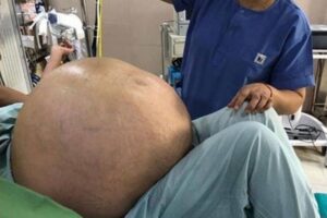 Mujer en Italia fue operada de un tumor en el abdomen que pesaba más de 50 kilos