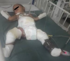 Solicitan ayuda económica e insumos para bebé que sufrió quemaduras en Ciudad Ojeda: está recluido en el Coromoto
