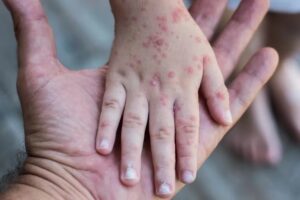 Florida declaró alerta de salud por casos de sarampión en condado de Broward - AlbertoNews