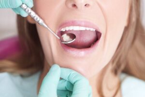 Los pacientes anticoagulados no deben suspender por sistema su medicación antes de una extracción o un implante dental