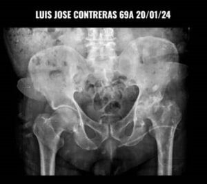 Luis Contreras, funcionario del INEA requiere ayuda urgente para una prótesis de cadera