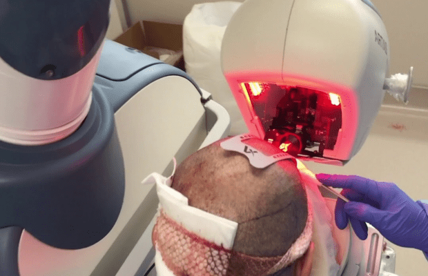 El robot más avanzado en materia de trasplante capilar está en Venezuela