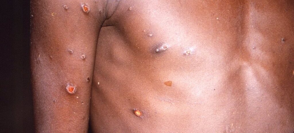 El ECDC asegura que el riesgo de que llegue la nueva variante de mpox a Europa es "muy bajo"