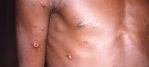 El ECDC asegura que el riesgo de que llegue la nueva variante de mpox a Europa es "muy bajo"