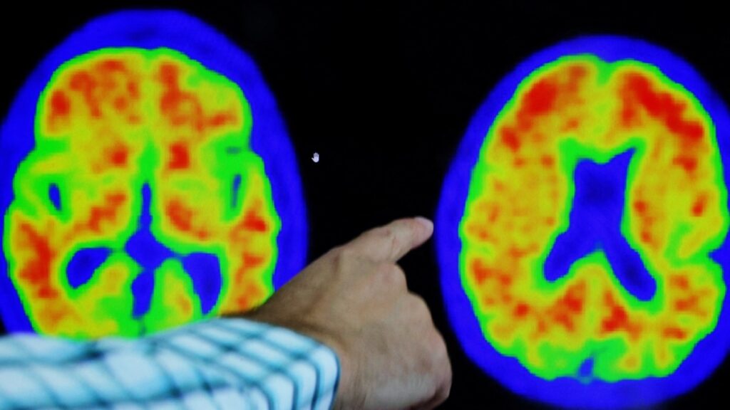 El fármaco contra el Alzheimer de Eisai y Biogen sufre un revés en Europa
