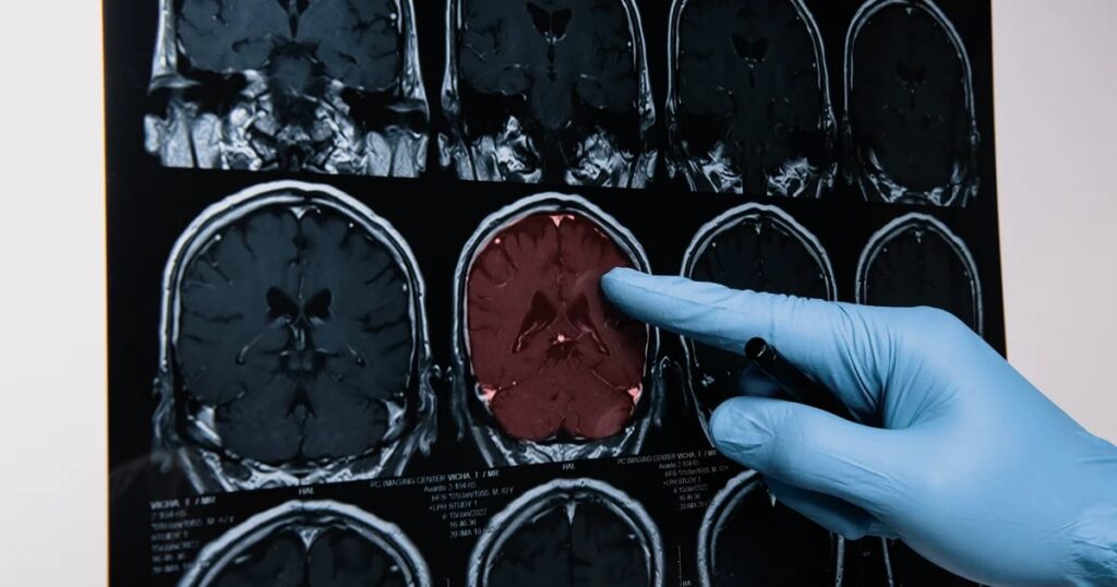 Hallan una nueva forma de pérdida de memoria que se confunde con el Alzheimer