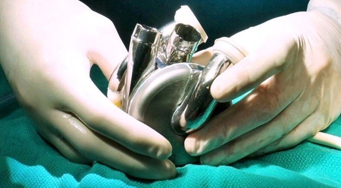 Implantan en un paciente el primer corazón artificial