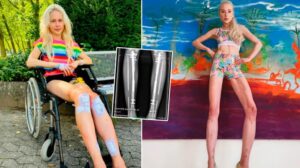 La historia de la modelo alemana que gastó USD 162.000 para alargarse las piernas por pedido de su exesposo - AlbertoNews