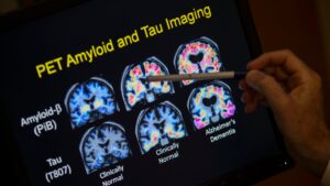Los análisis de sangre para detectar el Alzheimer podrían estar a la vuelta de la esquina
