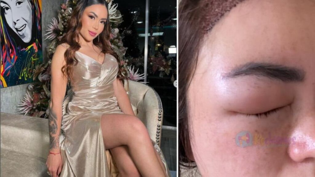 ‘Epa Colombia’ mostró cómo quedó su rostro tras someterse a un procedimiento estético