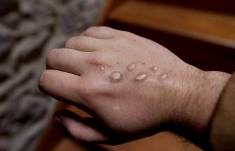 China refuerza controles fronterizos ante la propagación del virus del mpox - AlbertoNews