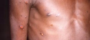 Confirmaron 584 muertes por la viruela del mono en el Congo y la OMS espera más casos en Europa - AlbertoNews