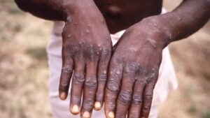 Mpox no es el nuevo COVID, aclara funcionario de la OMS