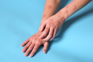 Sanidad y CC.AA. acuerdan no vacunar a todos los viajeros que acudan a países con casos de mpox