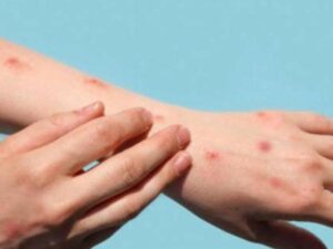 Virus mpox: Colombia está entre los 5 países con más casos positivos | Finanzas | Economía