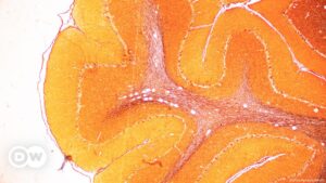 Científicos buscan rejuvenecer cerebros con tejido cultivado – DW – 11/09/2024