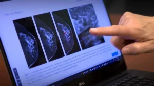 El cáncer de mama sigue siendo letal en mujeres del país
