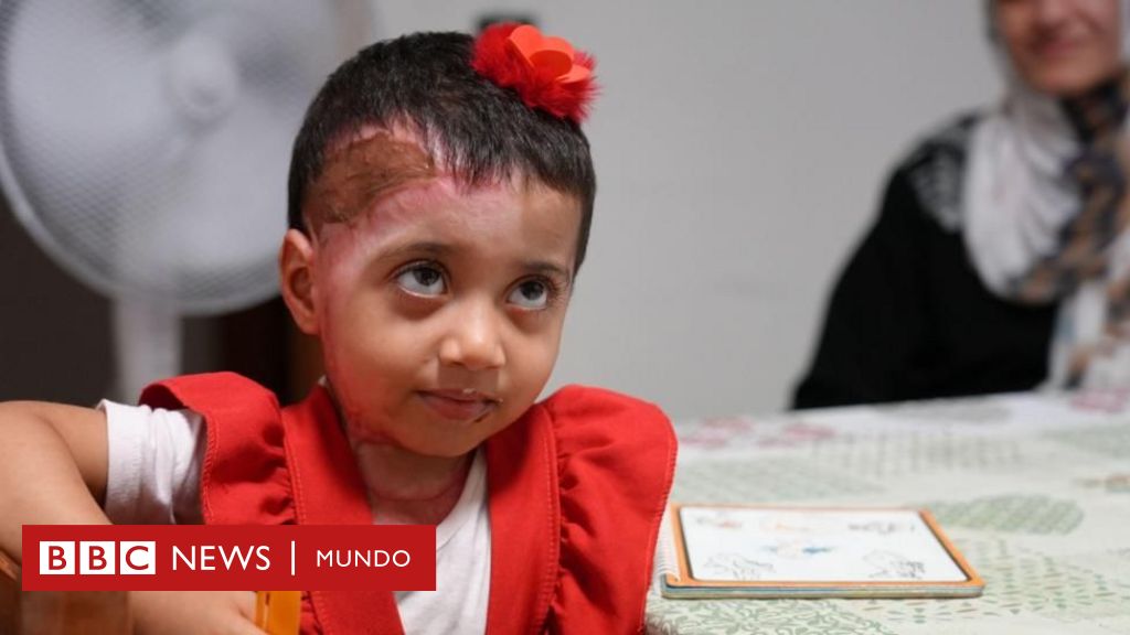 Israel- Gaza: "Estoy feliz de curarme, pero triste por la gente de Gaza", las niñas palestinas que reciben tratamiento contra sus quemaduras en Italia tras meses de espera