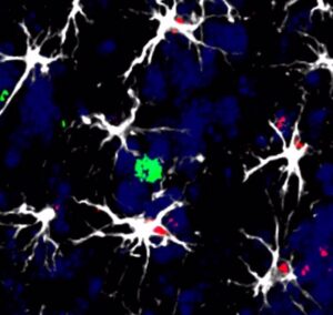 Proponen un nuevo tratamiento para la metástasis cerebral basado en la inmunoterapia