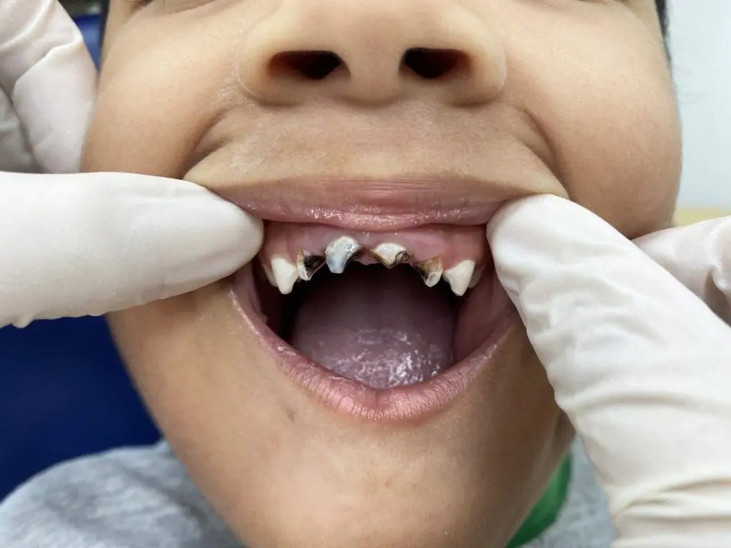 Aumentan las enfermedades dentales en niños por la malnutrición