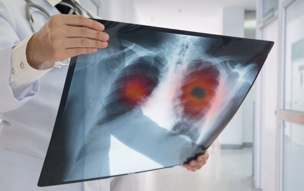 La tasa de supervivencia del cáncer de pulmón experimenta una "mejora significativa" en los últimos años