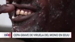 La cepa más grave de viruela del mono llega a Estados Unidos, según los CDC