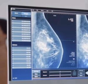 Llega a Venezuela un software que detecta cáncer de mama y tiroides