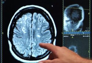 ¿Qué factores de riesgo están relacionados con un ictus grave?