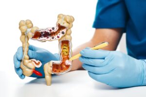 Cáncer intestinal aumenta entre jóvenes de todo el mundo | Diario El Luchador