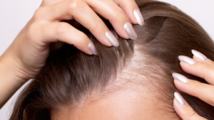 Estos son los peinados que causan alopecia en las mujeres