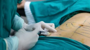 Mujer murió tras practicarse una liposucción en su vivienda en Medellín - AlbertoNews