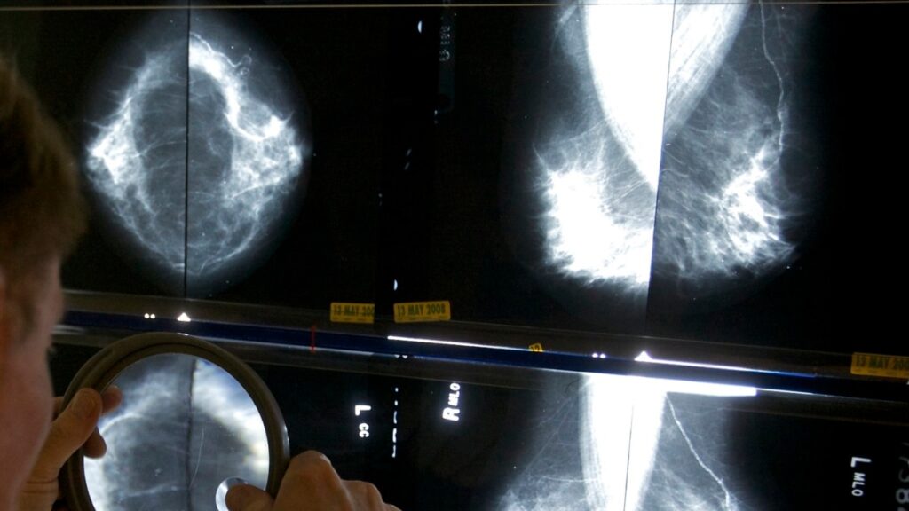 Reducción histórica en mortalidad por cáncer en EEUU pero preocupa aumento en mujeres y jóvenes