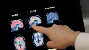 Vivir más tiempo podría aumentar el riesgo de demencia, pero hay formas de reducirlo