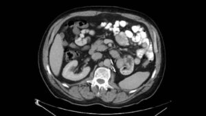 Prototipo de vacuna da resultados prometedores en un tipo de cáncer avanzado - AlbertoNews