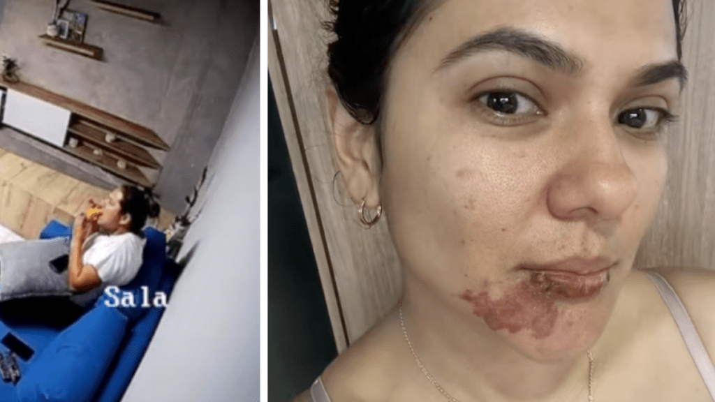 Colombiana sufrió grave quemadura luego que comerse una empanada: 'Explotó'