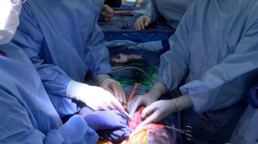 Un hígado de cerdo modificado genéticamente podría funcionar trasplantado en una persona