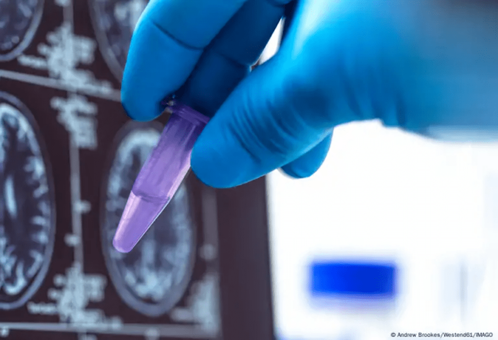Bruselas autoriza el lecanemab contra el alzhéimer en ciertos grupos de pacientes